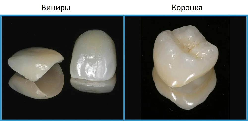 виниры или коронки