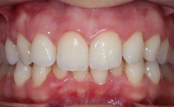 Лечение скученности зубов на элайнерах