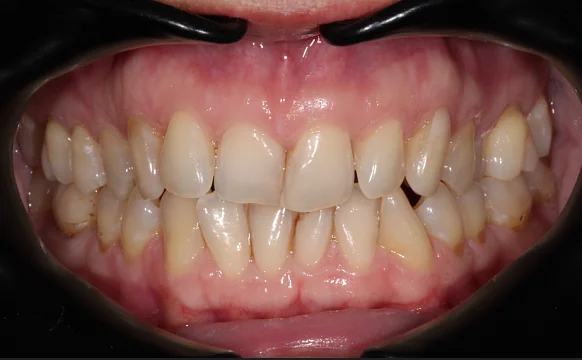 Коррекция аномалии соотношений зубных дуг элайнерами