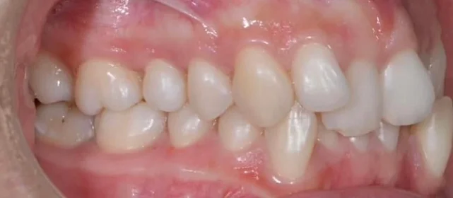 Ортодонтическое лечение на брекетах