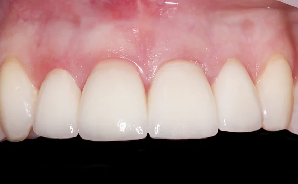 Устранение эстетического дефекта винирами