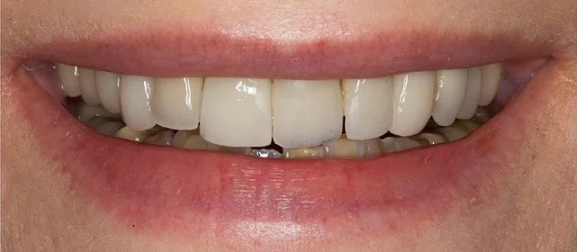 Установка виниров