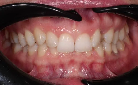 Коррекция дистальной окклюзия на брекет-системе