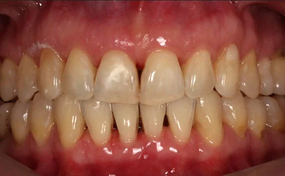 Коррекция аномалии соотношений зубных дуг элайнерами