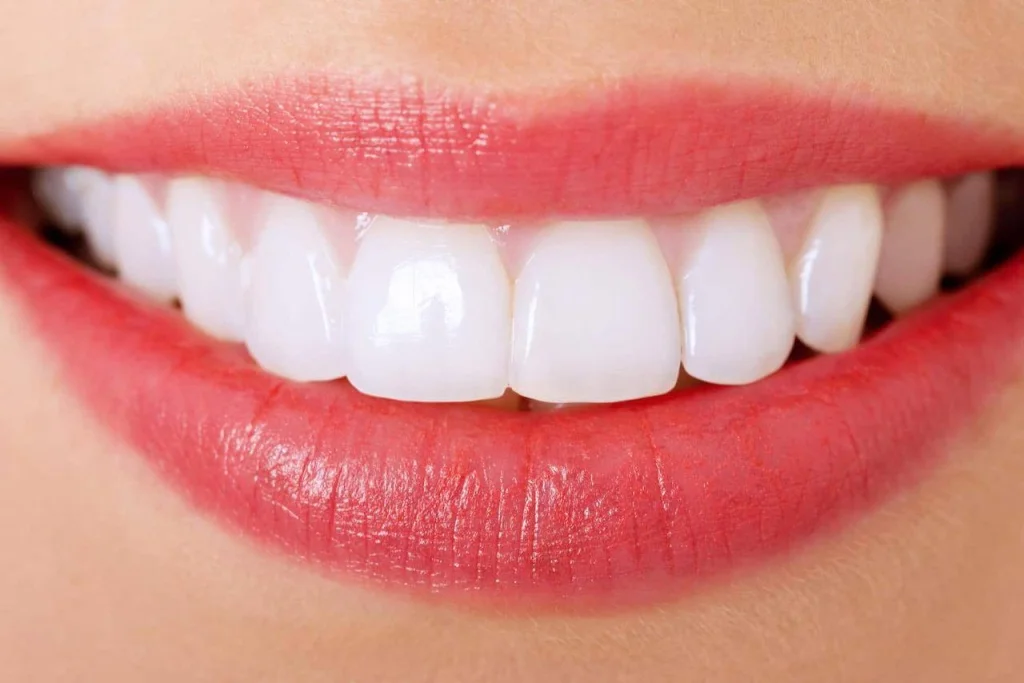 стоимость виниров