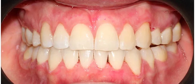 Ортодонтическое лечение на элайнерах №4