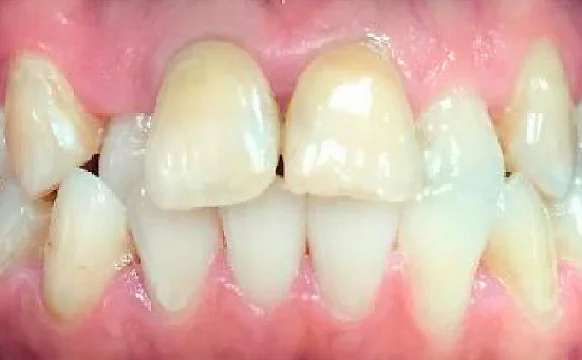 Исправление прикуса. 38 кап, 19 месяцев лечения