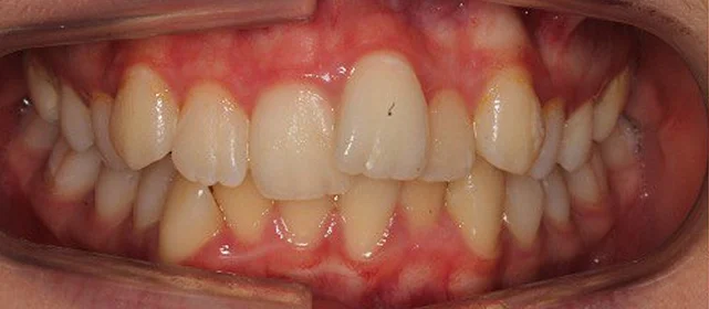 Ортодонтическое лечение на элайнерах №6