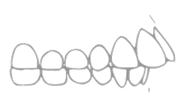 Выпирающий ряд зубов