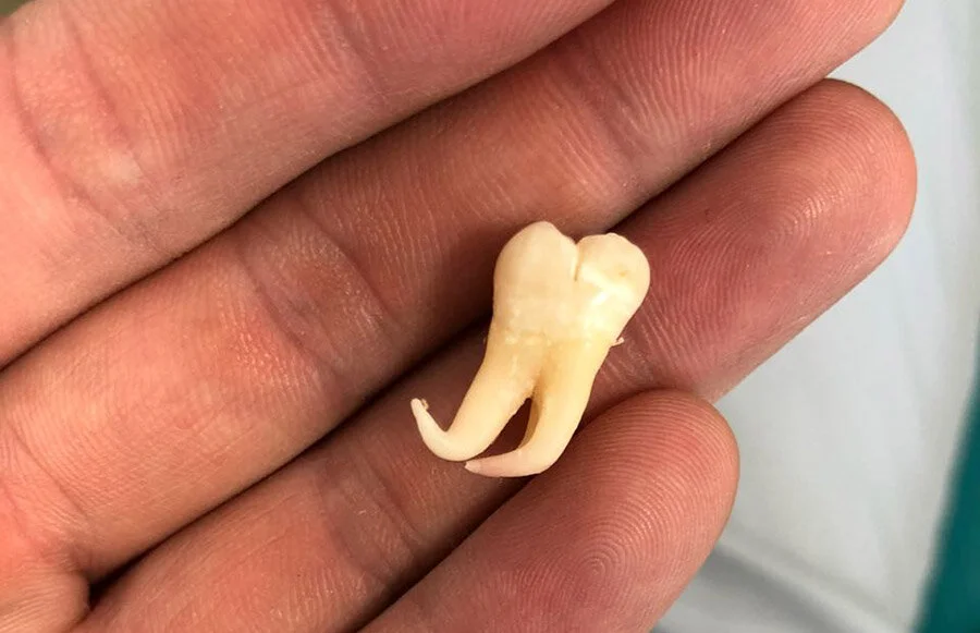 зуб мудрости фото