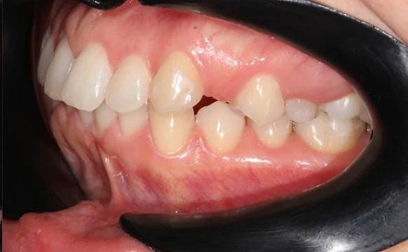 Ортодонтическое лечение на системе Click №1