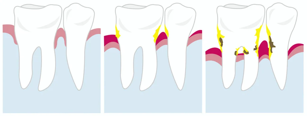 пародонтоз - изображение 2
