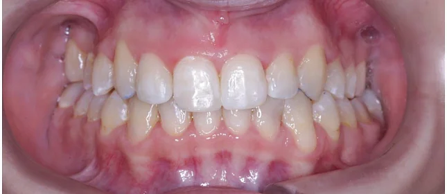 Ортодонтическое лечение на элайнерах №3