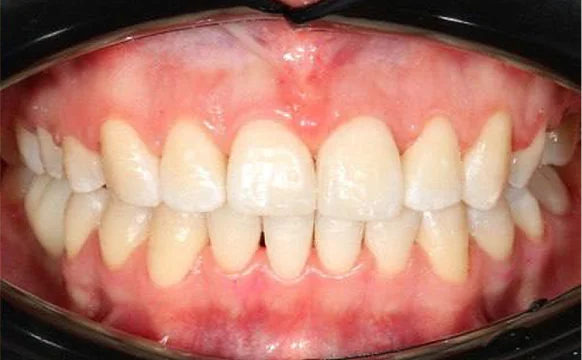 Ортодонтическое лечение на брекет-системе №1