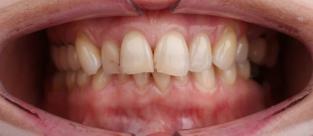 Лечение скученности зубов на брекет-системе