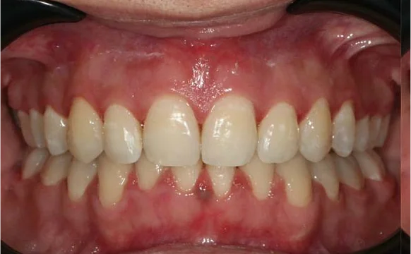 Ортодонтическое лечение на брекет-системе №2