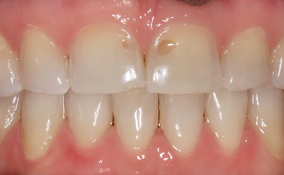 Нормализация смыкания и устранение скученности