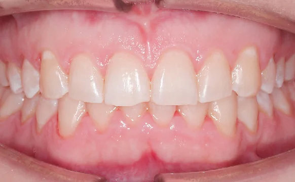 Исправление прикуса. 17 кап, 9 месяцев лечения