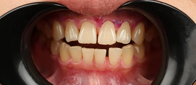 Ортодонтическое лечение на элайнерах №10