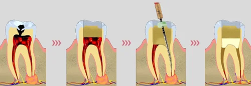 киста зуба лечение фото