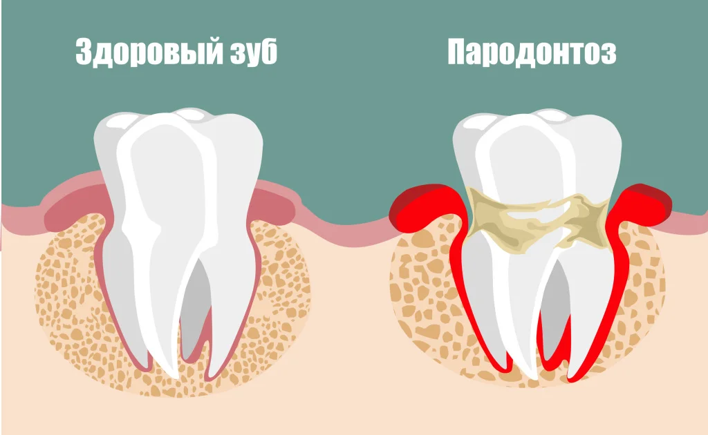 пародонтоз - изображение 1