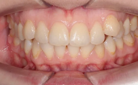 Лечение скученности зубов элайнерами