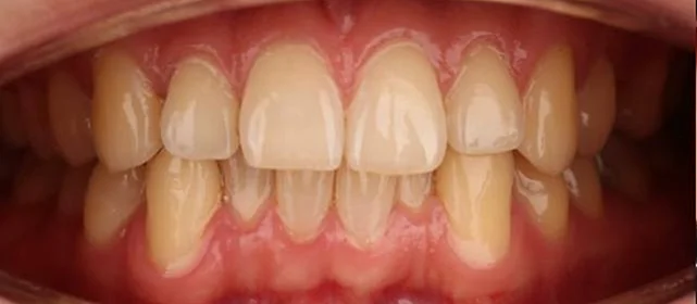 Ортодонтическое лечение на элайнерах №2