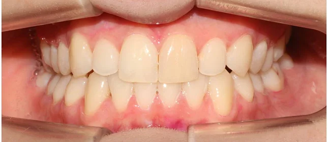 Ортодонтическое лечение на системе Click №2