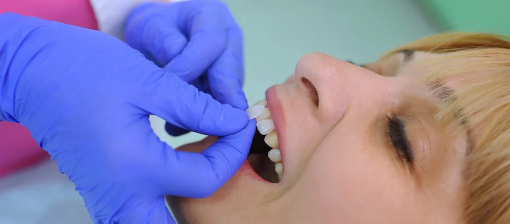 выравнивание зубов