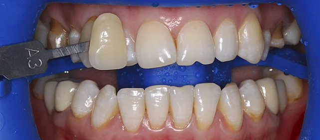 Отбеливание линии улыбки системой ZOOM 4