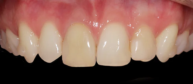 Улучшение эстетики верхних зубов после ортодонтического лечения