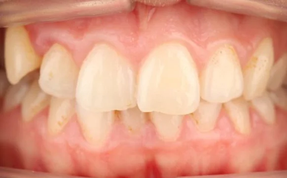 Ортодонтическое лечение нa брекет-системе