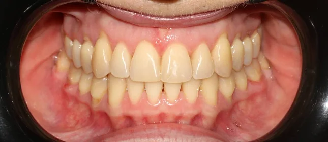 Ортодонтическое лечение на элайнерах