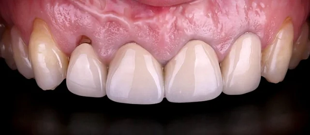 Протезирование верхней челюсти в комплексе с хирургической реабилитацией мягких тканей