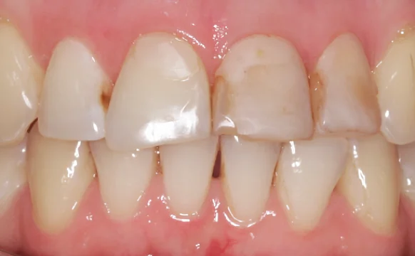 Подготовка зубных рядов к последующей установке виниров