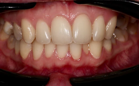 Лечение аномалии соотношения зубных дуг элайнерами