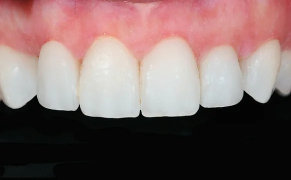 Восстановление эстетики винирами