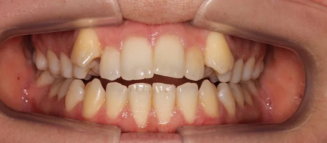 Корреция открытого прикуса элайнерами