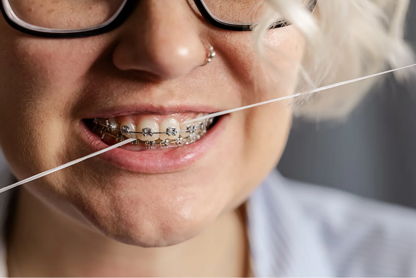 Что такое брекеты и зачем они нужны?
