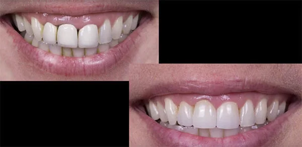 установка коронки фото