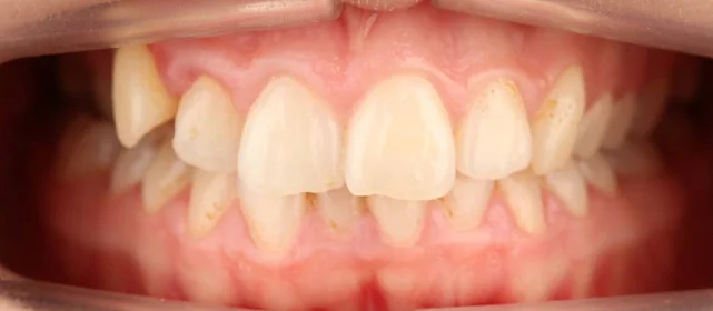 Ортодонтическое лечение нa брекет-системе