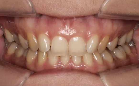 Ортодонтическое лечение на элайнерах №9