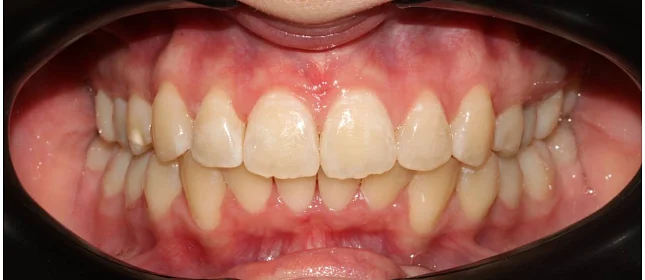 Ортодонтическое лечение на системе Click №5