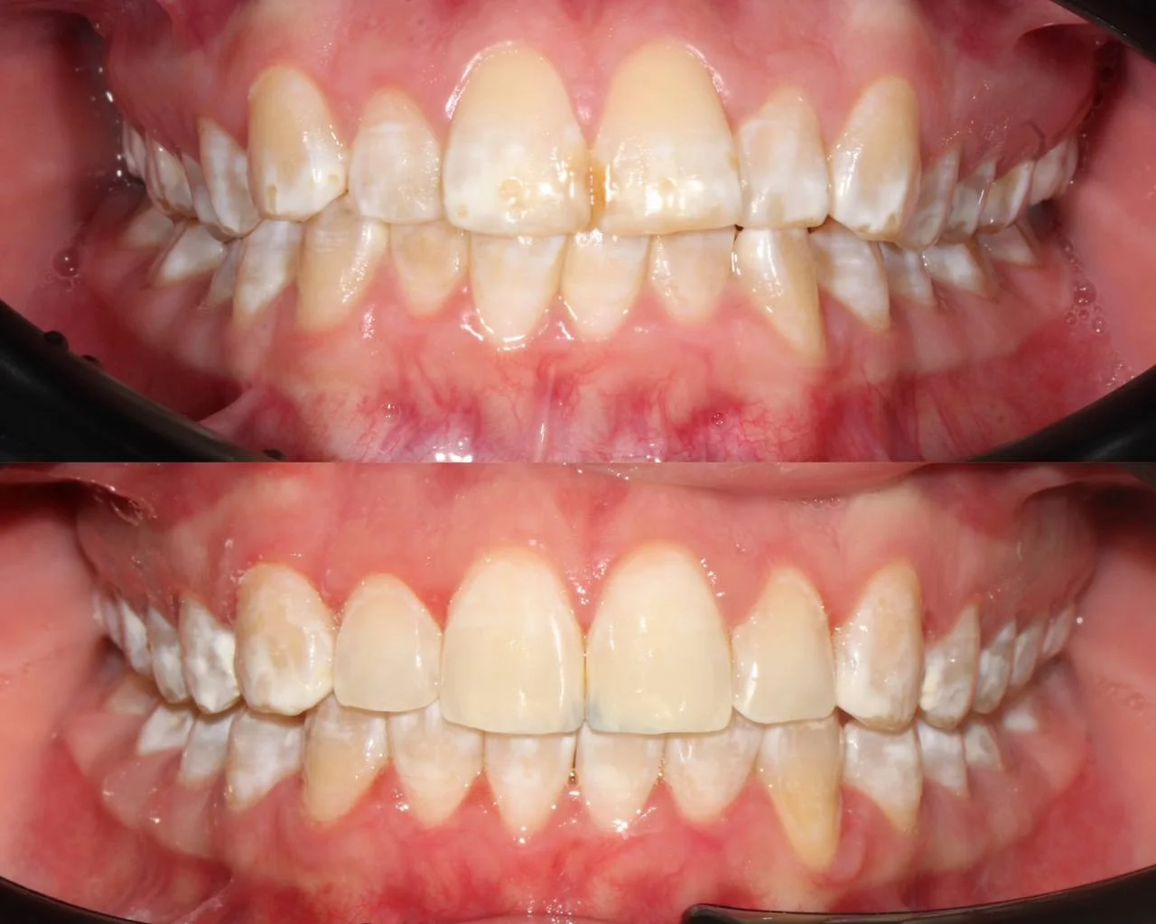 Лечение неправильного прикуса на элайнерах Click Aligners