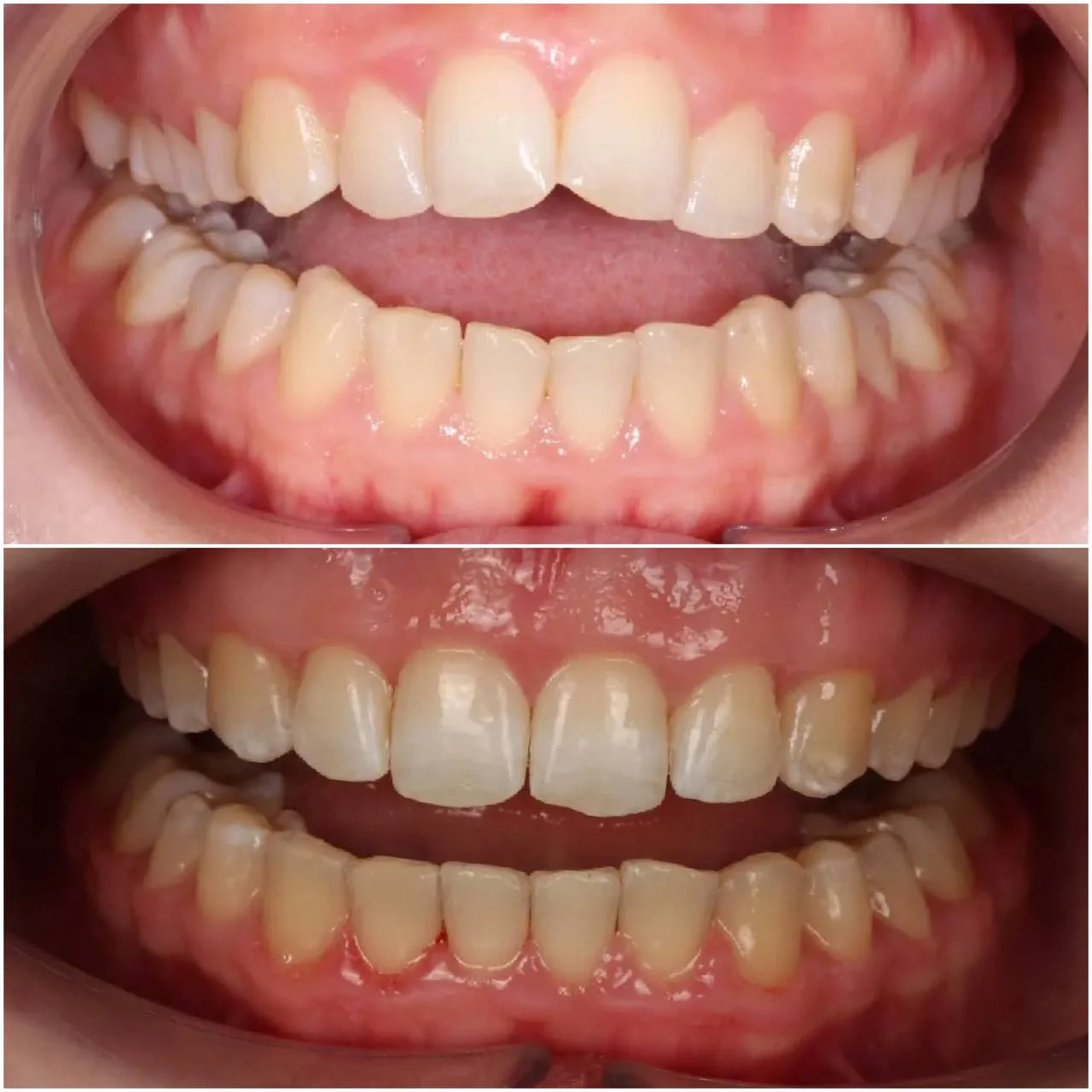 Лечим прикус на металлических брекетах H4 при сужении обеих челюстей за 25 месяцев