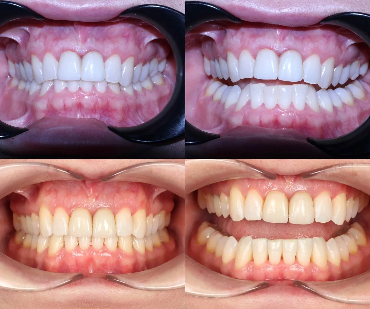 Скученность, глубокий прикус и старые коронки — лечение на элайнерах Click