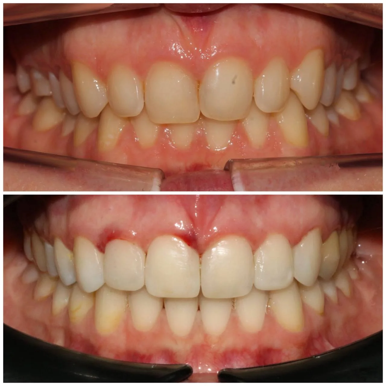 Выровняли и подготовили к реставрации зубы на керамических брекетах Damon за 14 месяцев