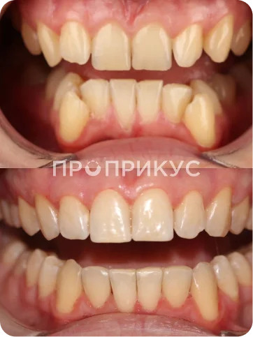 Ортодонтическое лечение зубов на брекет-системе Damon