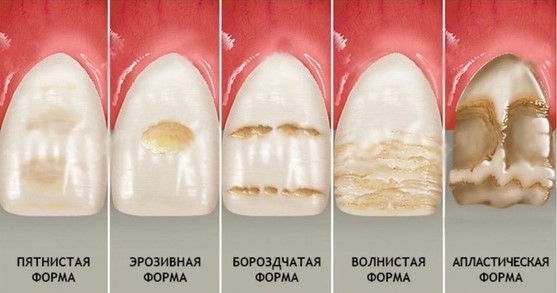 формы гипоплазии эмали фото