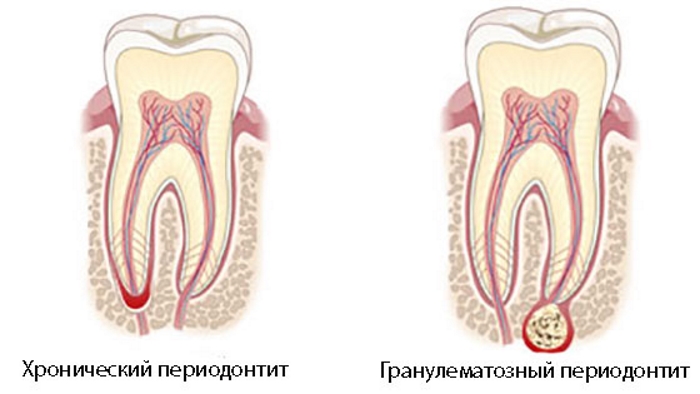 хронический периодонтит
